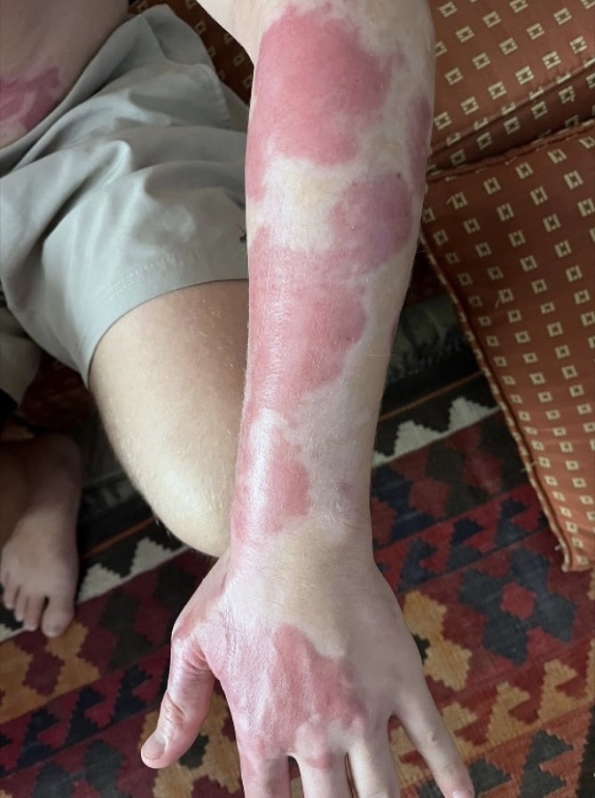 A healed burn scar on a client's forearm and hand